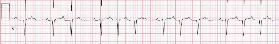 Focal atrial tachycardia: P-wave morphology indicates origin