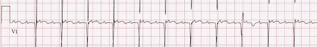 Atypical flutter — variable morphology; circuit defined by mapping