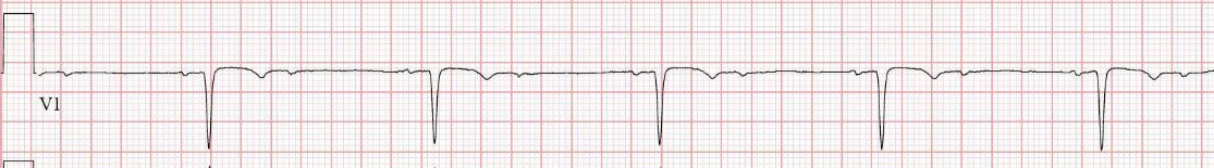 2:1 AV block (V1): alternating conducted and non-conducted P waves — site of block (nodal vs infranodal) determined by HV interval, response to atropine, and PR/QRS in conducted beats