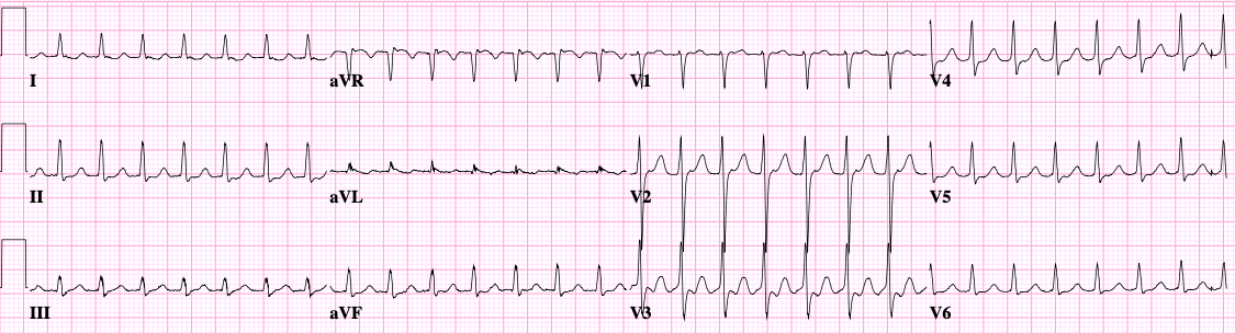 Narrow-complex regular tachycardia; pseudo-r' in V1 often present