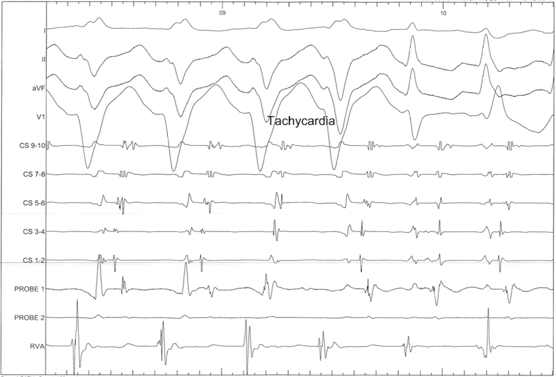 Orthodromic AVRT: narrow regular; pre-excited AF (rare) is irregular and wide