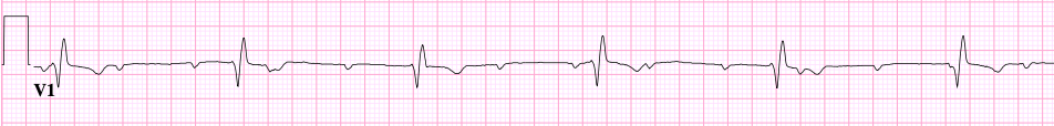3° AV block: independent atrial and ventricular rates