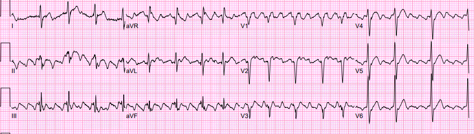 Typical (CTI-dependent) flutter: classic sawtooth in inferior leads