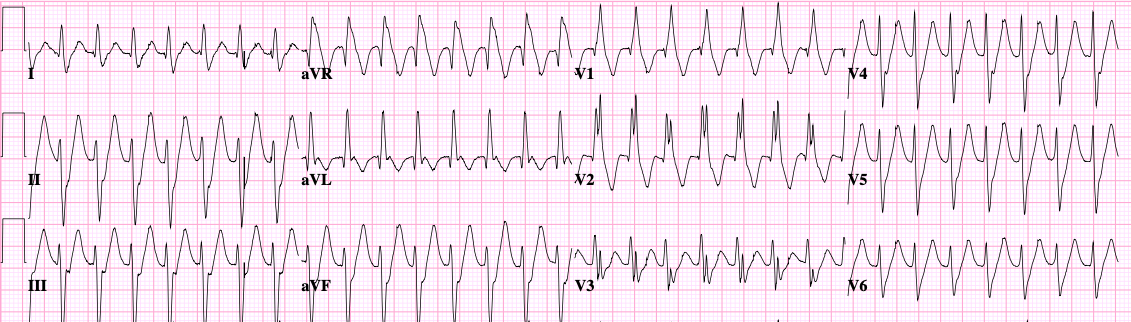 Monomorphic VT — uniform wide QRS